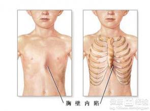 裤子松紧带太紧怎么改 裤子松紧带太紧怎么办 医生说,孩子缺钙是因为孩子的裤子松紧带太紧了!