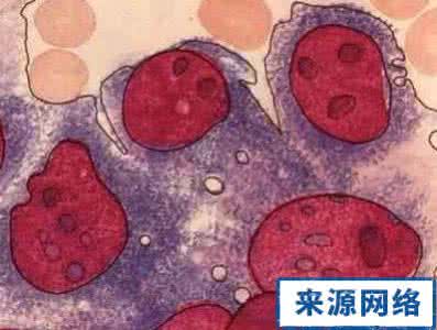 原发性肝癌早期症状 原发性肝癌晚期症状 原发性肝癌晚期症状 多为这几种
