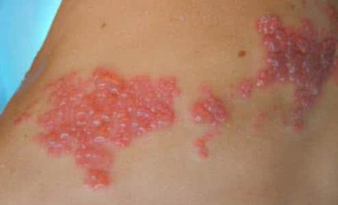 带状疱疹该怎么治疗 带状疱疹是怎么引起的 治疗要注意什么