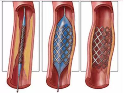 心脏支架最多能放几个 「支架」是如何放进心脏的?