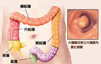 大便稀是结肠炎吗 结肠炎的大便症状 大便不成型、结肠炎，疗效奇佳，100%有效