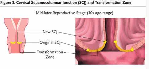 宫颈柱状上皮异位 宫颈柱状上皮异位 什么是宫颈柱状上皮异位