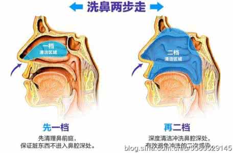 治疗鼻炎最有效的方法 治疗鼻炎 治疗鼻炎的有效方法