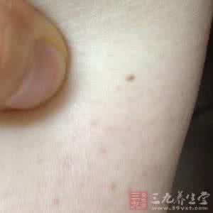 鼻梁有一颗痣有好运吗 身体这处长了痣不愁没好运