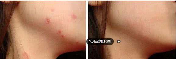 怎样快速治疗疥疮 快速治疗疥疮 怎么快速治好疥疮？