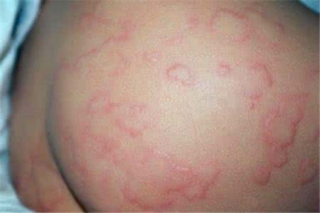 荨麻疹根治方法偏方 如何才能使荨麻疹断根 根治荨麻疹的4大法