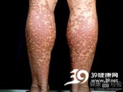 免疫性血小板减少紫癜 血小板减少紫癜 血小板减少紫癜病因