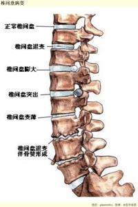 椎间盘病变是什么意思  椎间盘病变