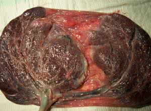 胎盘大是怎么造成的 胎盘大怎么办