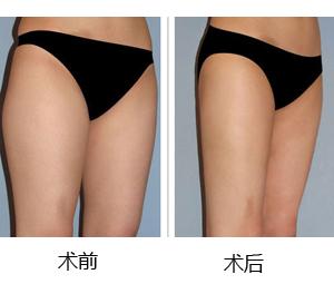 提臀瘦腿的方法 提臀瘦腿的方法 提臀手术方法