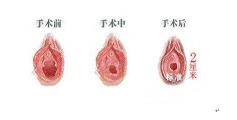 谈谈女性处女膜修复手术的风险