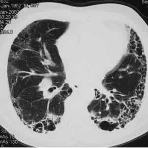 肺间质纤维化的治疗 肺间质纤维化 为什么会发生肺间质纤维化