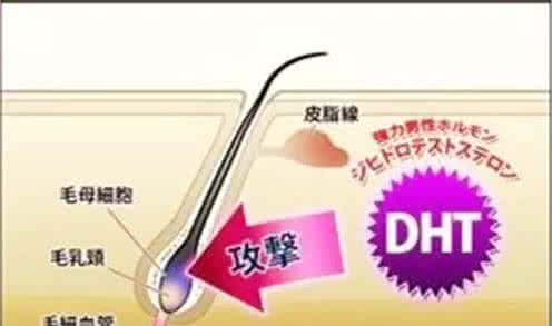 遗传性脱发能不能治疗 解密:遗传性脱发到底能不能根治?