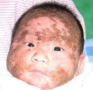 婴儿湿疹症状图片 湿疹初期症状图片 父母须知五点婴儿湿疹的初期症状