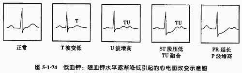 周期性麻痹的治疗 周期性麻痹 周期性麻痹的四个类型