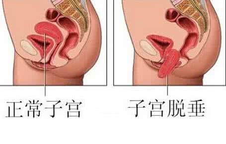 子宫下垂会使月经量多 月经子宫下垂有什么症状呢