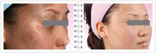 治疗太田痣最好的医院 太田痣 专家简述太田痣