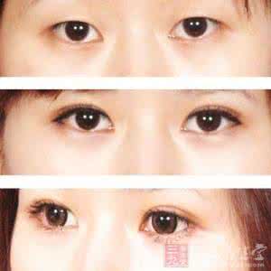割双眼皮的后遗症 割双眼皮的后遗症 做双眼皮的后遗症