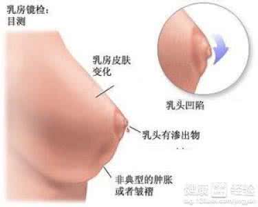 乳腺纤维瘤有什么症状 乳腺纤维瘤有什么预防措施