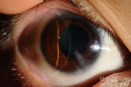 角膜炎的治疗方法 角膜炎治疗方法 这些方法可以治疗角膜炎