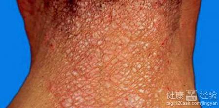 治疗神经性皮炎哪里好 ：神经性皮炎真的没办法治好吗?那最有效的止痒方法是什么?