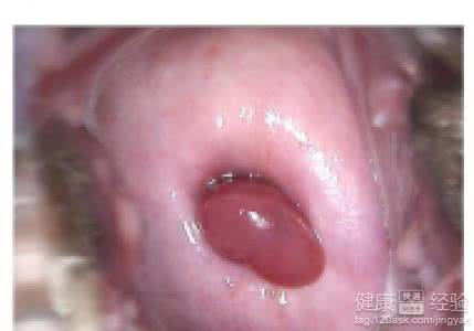 药流后流血多少算正常 药流后出血多久