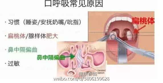 儿童张口呼吸纠正器 张口呼吸怎么纠正？