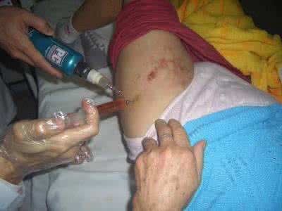 治疗股骨头坏死症状 什么是股骨头坏死 股骨头坏死的症状与治疗