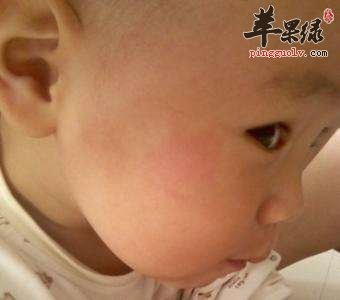 宝宝脸上粗糙发红图片 宝宝脸上粗糙发红图片 宝宝脸上发红的原因