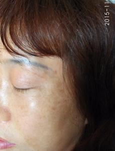 面部色斑的种类 面部色斑 面部色斑区分种类“激光”治