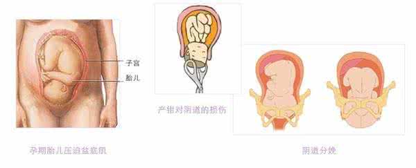 产后盆底修复多少钱 产后盆底肌康复 我需要做产后盆底肌康复吗？