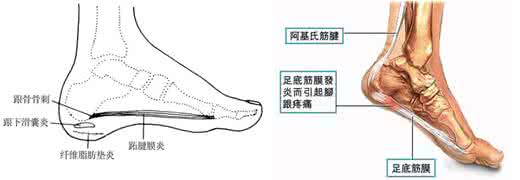 脚后跟靠近足弓处疼 脚后跟疼是怎么回事 足根痛的六大病因