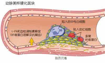 动脉硬化的原因 动脉硬化的原因 动脉硬化的原因