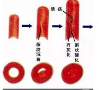 心脏血管堵塞吃什么好 40岁后，每天吃一点，清血管，心脏好，人长寿!