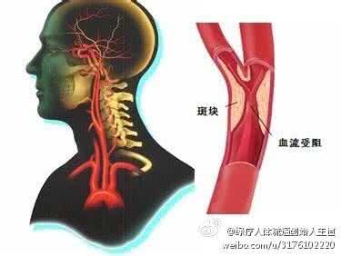 动脉血管内皮的保护 保护好动脉（值得一看）