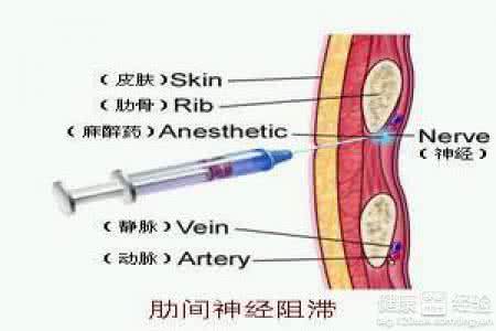 肋间神经痛的治疗方法 肋间神经痛的治疗方法有哪些