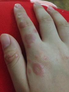 手上长湿疹怎么治疗 手上湿疹 手上湿疹怎么治疗