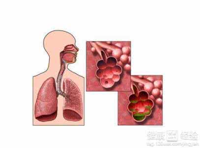 治疗肺气肿的民间偏方 肺气肿偏方 肺气肿的一些常见症状
