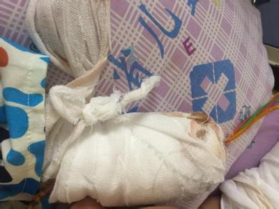 全身淤青 男童术后全身多处淤青 家长称医生术中玩手机