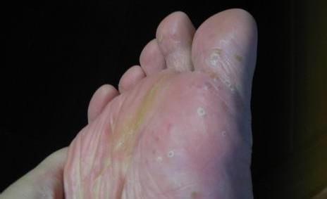 水泡型脚气治疗方法 水泡型脚气的治疗方法 中药治脚气更加彻底