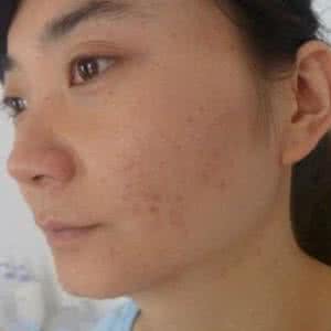 光子嫩肤去痘印的价格 痘印 光子嫩肤祛斑的价格