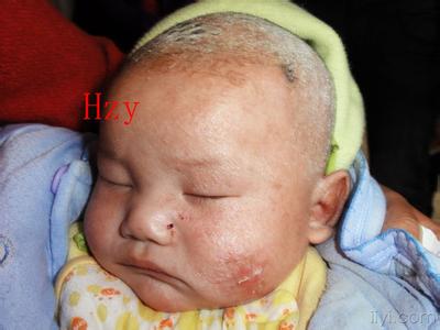 婴儿脂溢性皮炎和湿疹 婴儿脂溢性皮炎和湿疹 婴儿皮炎湿疹怎么治?