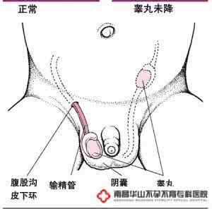 隐睾症治疗方法 隐睾症怎么治疗 治疗男人隐睾症的方法