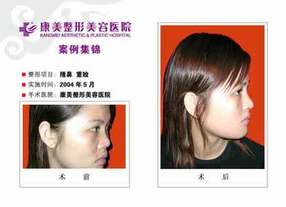 眼部整形美容手术图谱 整形美容前后对比 整形美容手术前后对比!