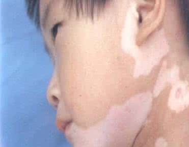 荨麻疹的有效治疗方法 白癜风的治疗方法 有哪些方面的