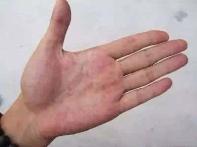 怎么判断自己肝好不好 肝脏好不好，看看你手掌