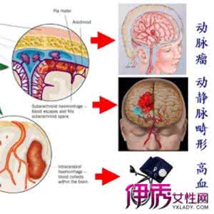 高血压怎样预防脑出血 高血压脑出血 高血压脑出血怎样饮食