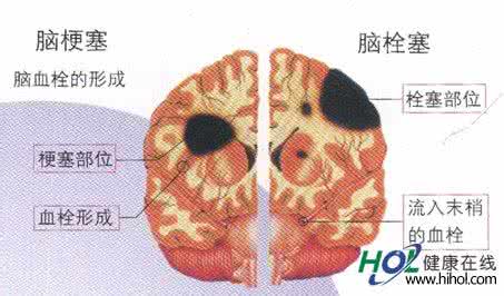 脑血栓和脑梗塞的区别 怎樣分清腦出血,腦血栓,腦梗塞