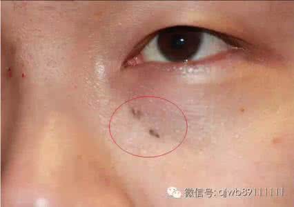 如何去除鸡皮肤小窍门 如何去除皮肤上的黑痣