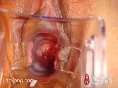 女性尖锐疣复发治疗 尖锐疣复发后如何治疗？